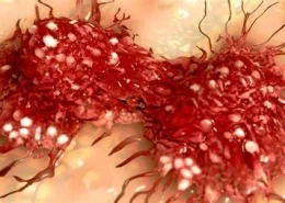Quelle est la différence entre un cancer et une tumeur ?